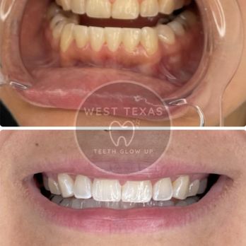 West Texas Teeth Glow Up - Teeth Whitening Near Me - Midland, Texas West Texas Teeth Glow Up - Teeth Whitening Near Me - Midland, Texas