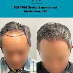 8 months post-FUE hair transplant, 1984 grafts. Results supported by post-op care, PRP, and medical therapy. Results may vary. Portland, OR