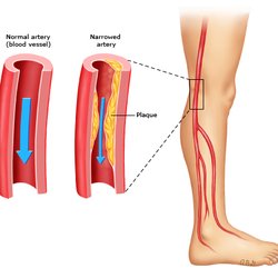 RIA Endovascular