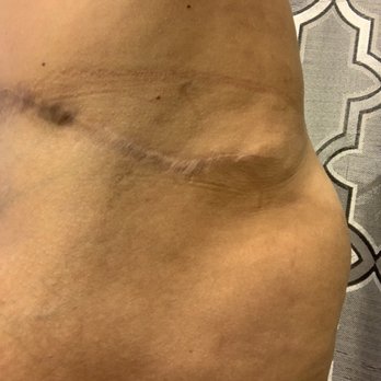 Daniel G Kolder, MD - Pacifica Center for Plastic Surgery - My side after surgery with Dr, Kolder ! - Cosmetic Surgeons Near Me - Camarillo, California
