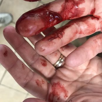 Curtis Hall Dog Park - Injuries I suffered yesterday in the big Dog park, prying open the jaws of a dog who had attacked and sunk its teeth into an older dog. - Dog Parks Near Me - Wyncote, Pennsylvania