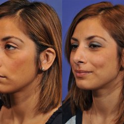 Jesse E Smith, MD, FACS - Rhinoplasty Before & After #6