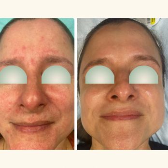 512 Skincare - BBL + Microneedling + Chemical Peels! - Skin Care Near Me - Austin, Texas 512 Skincare - BBL + Microneedling + Chemical Peels! - Skin Care Near Me - Austin, Texas