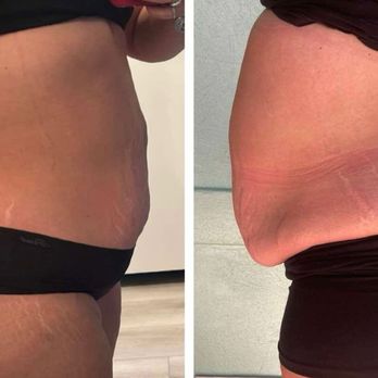 Perfect Skin and Brows - RF Skin Tightening Fat Cavitation Before and After at least 2 sessions! - Permanent Makeup Near Me - Ormond Beach, Florida Perfect Skin and Brows - RF Skin Tightening Fat Cavitation Before and After at least 2 sessions! - Permanent Makeup Near Me - Ormond Beach, Florida