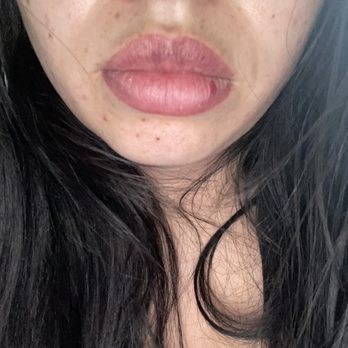 Lumière Spa - after it heeled my top lip now has a bunch of dark spots - Day Spas Near Me - Lodi, California