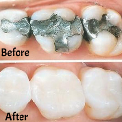 Craig Droskin, DDS - Beautiful White Fillings and Crowns
