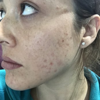 The Modern Ū - after 4 days - Acne Treatment Near Me - Los Angeles, California The Modern Ū - after 4 days - Acne Treatment Near Me - Los Angeles, California