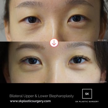 SK Plastic Surgery - Patient underwent upper blepharoplasty via incisional approach. Lower blepharoplasty via non-incisional transconjunctival approach. - Cosmetic Surgeons Near Me - Beverly Hills, California SK Plastic Surgery - Patient underwent upper blepharoplasty via incisional approach. Lower blepharoplasty via non-incisional transconjunctival approach. - Cosmetic Surgeons Near Me - Beverly Hills, California