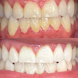 Teeth whitening after first visit