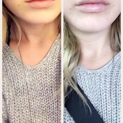 Rejuv Laser Spa