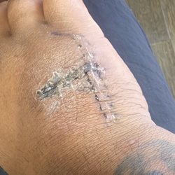 Hand & Wrist Center of Houston - 2 weeks after post op