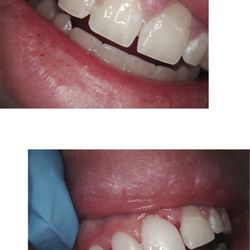 Dental Matrix Dr. Quinn Yu, DDS - Same Day cosmetic treatment. Along with 3 week healing of gum treatment.