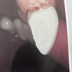 Pearland Accent Dental Group - Crack
