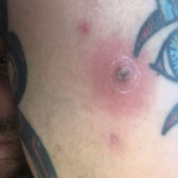 day of urgent care visit, infection located next to lower-center of the T.A.T tattoo
