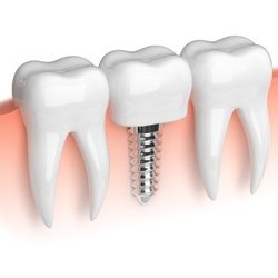 Ellettsville Dental Center - Dentist Bloomington, Indiana, Health Bloomington, General Dentistry Bloomington