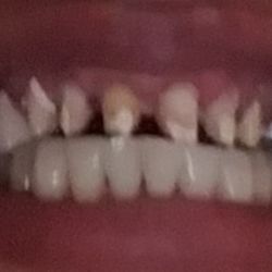 KEMM - Prep for veneers kemmclinix