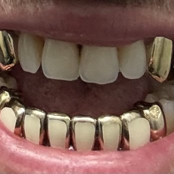 Florida Dental Solutions - Done exactly perfect 14k Gold - General Dentistry Near Me - Davie, Florida Florida Dental Solutions - Done exactly perfect 14k Gold - General Dentistry Near Me - Davie, Florida