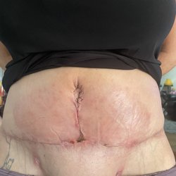 Maan Kattash MD - 2 weeks post op from a tummy tuck