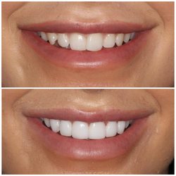 Veneers