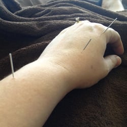 Neighborhood Acupuncture and Healing Arts - Getting some pain relief with acupuncture