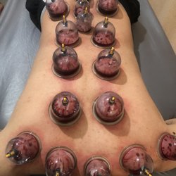 Certified Hijama-Cupping by Husain Abdul-Wahaab