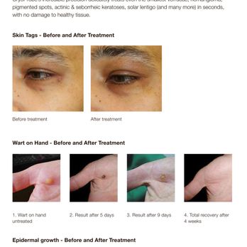 Lina Diminno Med Spa - Remove unsightly skin tags simply with NEW CryoProbe treatment - Medical Spas Near Me - King City, Ontario Lina Diminno Med Spa - Remove unsightly skin tags simply with NEW CryoProbe treatment - Medical Spas Near Me - King City, Ontario