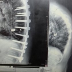 Roberto Rolando F MD Orthopaedic Surgery Spine - First surgery March 2012