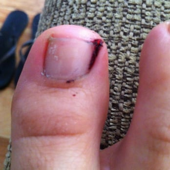 JC Nail Spa - Sliced off the entire corner of my cuticle/toe. Bled for hours and couldnt even finish the service. - Nail Salons Near Me - Denver, Colorado
