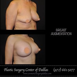 Rachel Walker MD: Plastic Surgery Center of Dallas - Breast augmentation