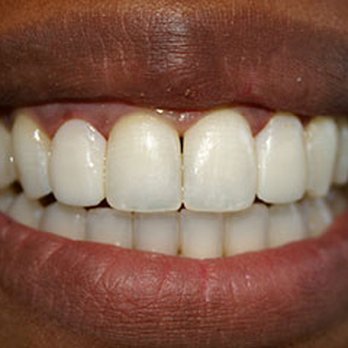 Preston Bend Dental - After Case 4 - General Dentistry Near Me - Plano, Texas