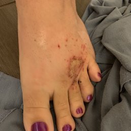 Here ya go . Pedi on Sunday infected Tuesday Here ya go . Pedi on Sunday infected Tuesday