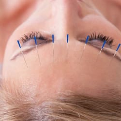 Elite Wellness North Shore - Acupuncture at Elite