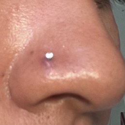 Irritation bump. Irritation bump.