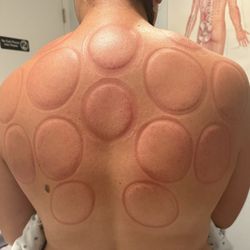 Acupuncture Healing Center - I did acupuncture and cupping