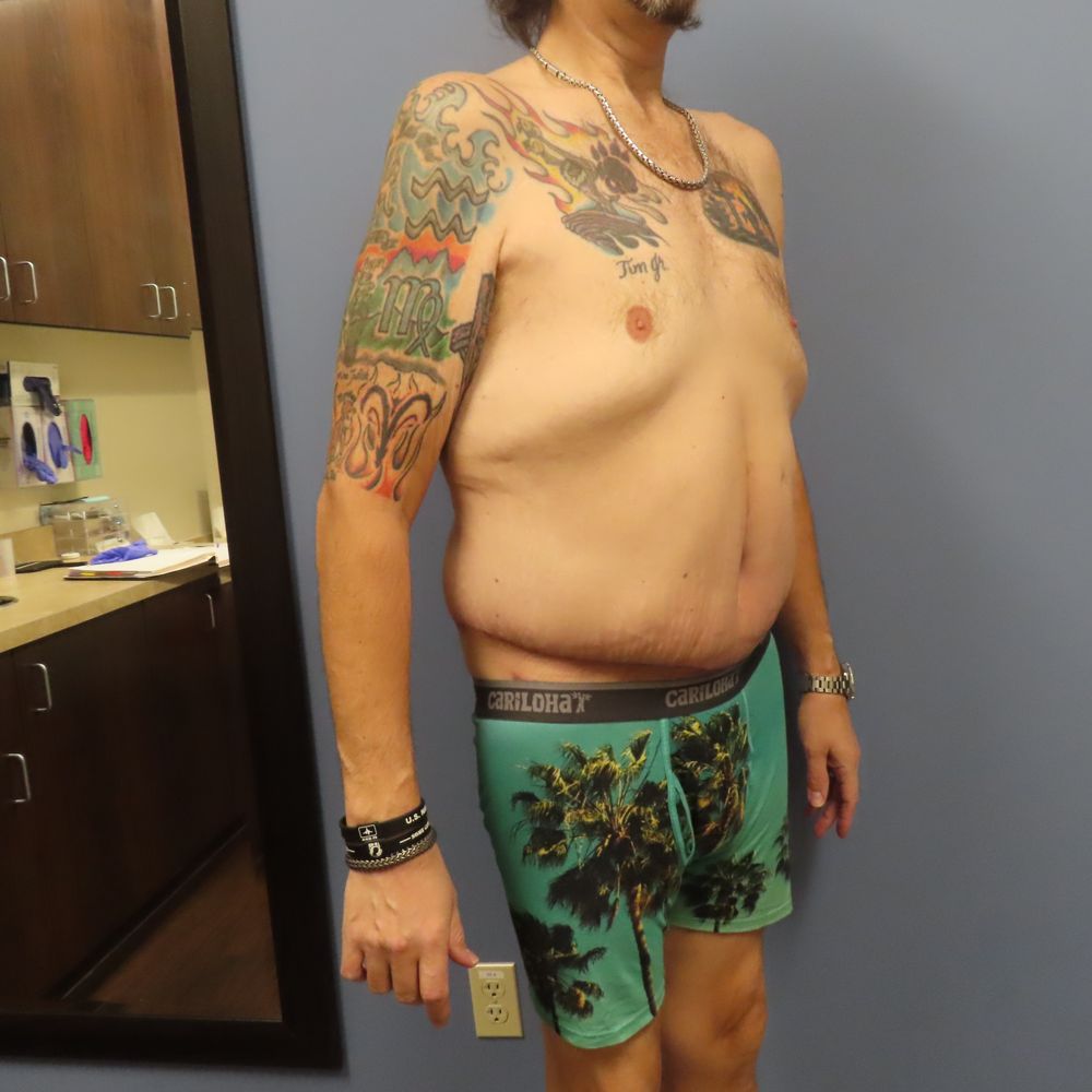 Matthew D Freeman, MD - 5 Weeks Post op - Plastic Surgeons Near Me - Denver, Colorado