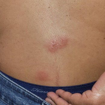 Hyatt Place Sumter / Downtown - Bed Bug Bites on Back - Hotels Near Me - Sumter, South Carolina Hyatt Place Sumter / Downtown - Bed Bug Bites on Back - Hotels Near Me - Sumter, South Carolina