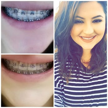 South Coast Dental Group - Top picture is on first day with braces and bottom picture is on my second month with braces. Up to date my teeth are still very straight =) - General Dentistry Near Me - Orange, California