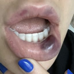 Lip filler blood Lip filler blood