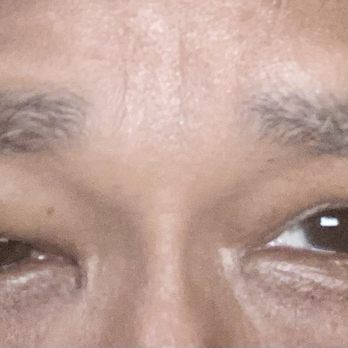 Michael Burnstine, MD - Pasadena Oculoplastic Surgeon - This the results of Doctor Burnstein's work! My eye looks worse than it did before I went into surgery - Ophthalmologists Near Me - Pasadena, California Michael Burnstine, MD - Pasadena Oculoplastic Surgeon - This the results of Doctor Burnstein's work! My eye looks worse than it did before I went into surgery - Ophthalmologists Near Me - Pasadena, California
