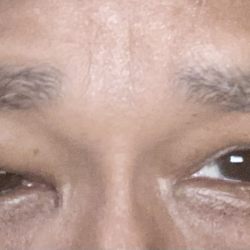 Michael Burnstine, MD - Pasadena Oculoplastic Surgeon - This the results of Doctor  Burnstein's work! My eye looks worse than it did before I went into surgery