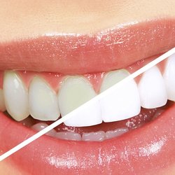 Beaming Smiles and Skincare - A brighter smile in 60 minutes
