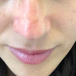Nova Medical Skin Care - This is the result after 3rd revlite session.