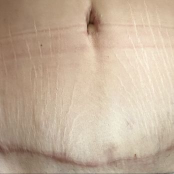 Brian M. Parrett, M.D - After - Plastic Surgeons Near Me - San Francisco, California Brian M. Parrett, M.D - After - Plastic Surgeons Near Me - San Francisco, California