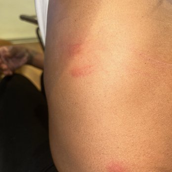 Orient Cafe Hookah Lounge - Bed bug bites from sitting on their chairs inside the Establishment - Hookah Bars Near Me - Philadelphia, Pennsylvania Orient Cafe Hookah Lounge - Bed bug bites from sitting on their chairs inside the Establishment - Hookah Bars Near Me - Philadelphia, Pennsylvania