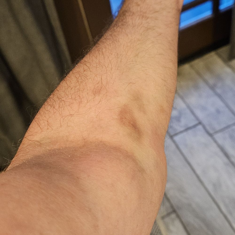 Rush Copley Medical Center - Left arm after the nurse of necrosis stuck a needle in my vein or attempted to - Medical Centers Near Me - Aurora, Illinois Rush Copley Medical Center - Left arm after the nurse of necrosis stuck a needle in my vein or attempted to - Medical Centers Near Me - Aurora, Illinois