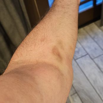Rush Copley Medical Center - Left arm after the nurse of necrosis stuck a needle in my vein or attempted to - Medical Centers Near Me - Aurora, Illinois
