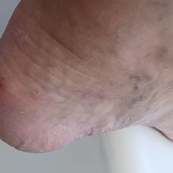 Both heels scraped
