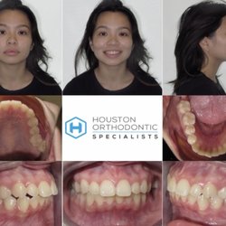Houston Orthodontic Specialists - Bellaire - Before