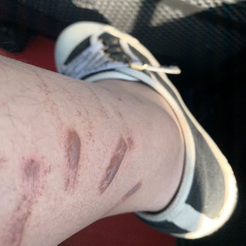 West End Medical Aesthetics - DOCTOR DOESN'T REPLY THE MESSAGE OR PHONE CALL AFTER MALPRACTICE!!! The blisters tell that how painful it is!! - Medical Spas Near Me - Pasadena, California
