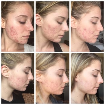 Emme Diane - October 21st 2015-December 19th 2015 (2 months approximately) - Skin Care Near Me - Scottsdale, Arizona Emme Diane - October 21st 2015-December 19th 2015 (2 months approximately) - Skin Care Near Me - Scottsdale, Arizona